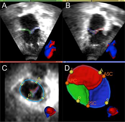Segmentation of Tricuspid Valve Leaflets From Transthoracic 3D Echocardiograms of Children With Hypoplastic Left Heart Syndrome Using Deep Learning